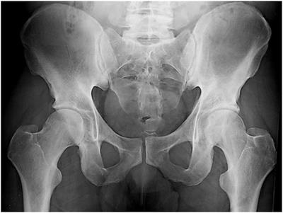 The Role of Imaging in Diagnosing Axial Spondyloarthritis